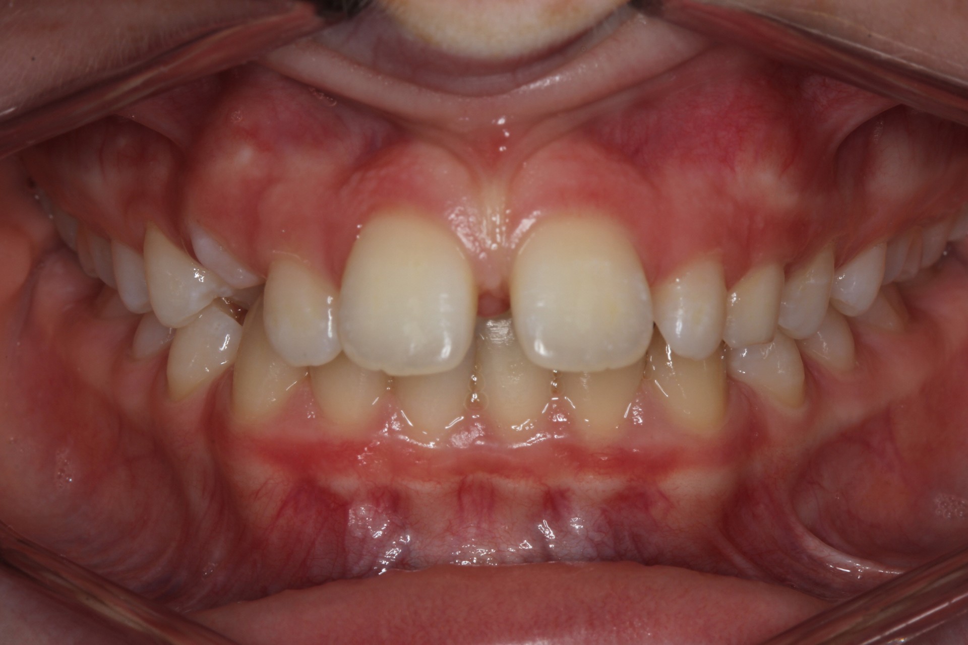 Protruding Front Teeth Contour Orthodontists