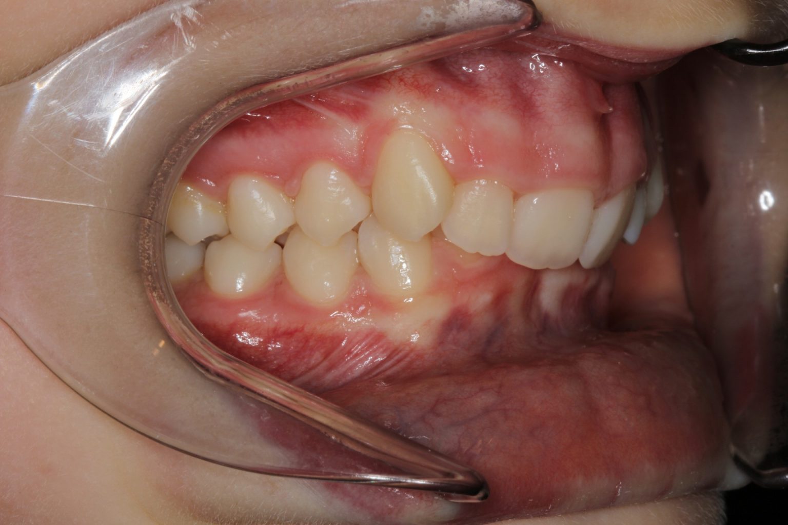 Bite Problems Contour Orthodontists