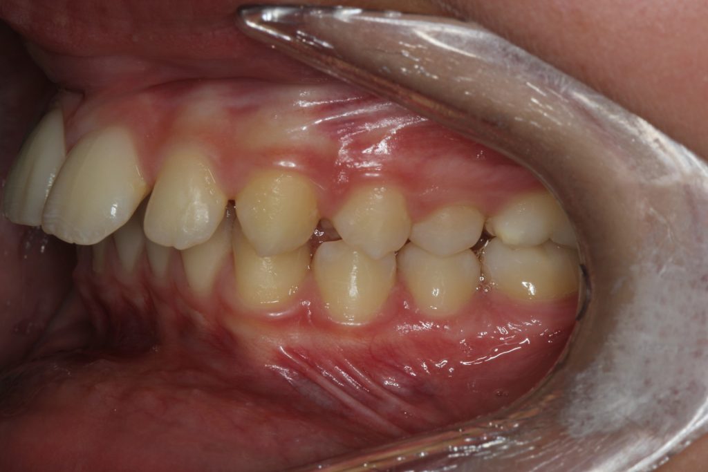 Protruding Front Teeth | Contour Orthodontists