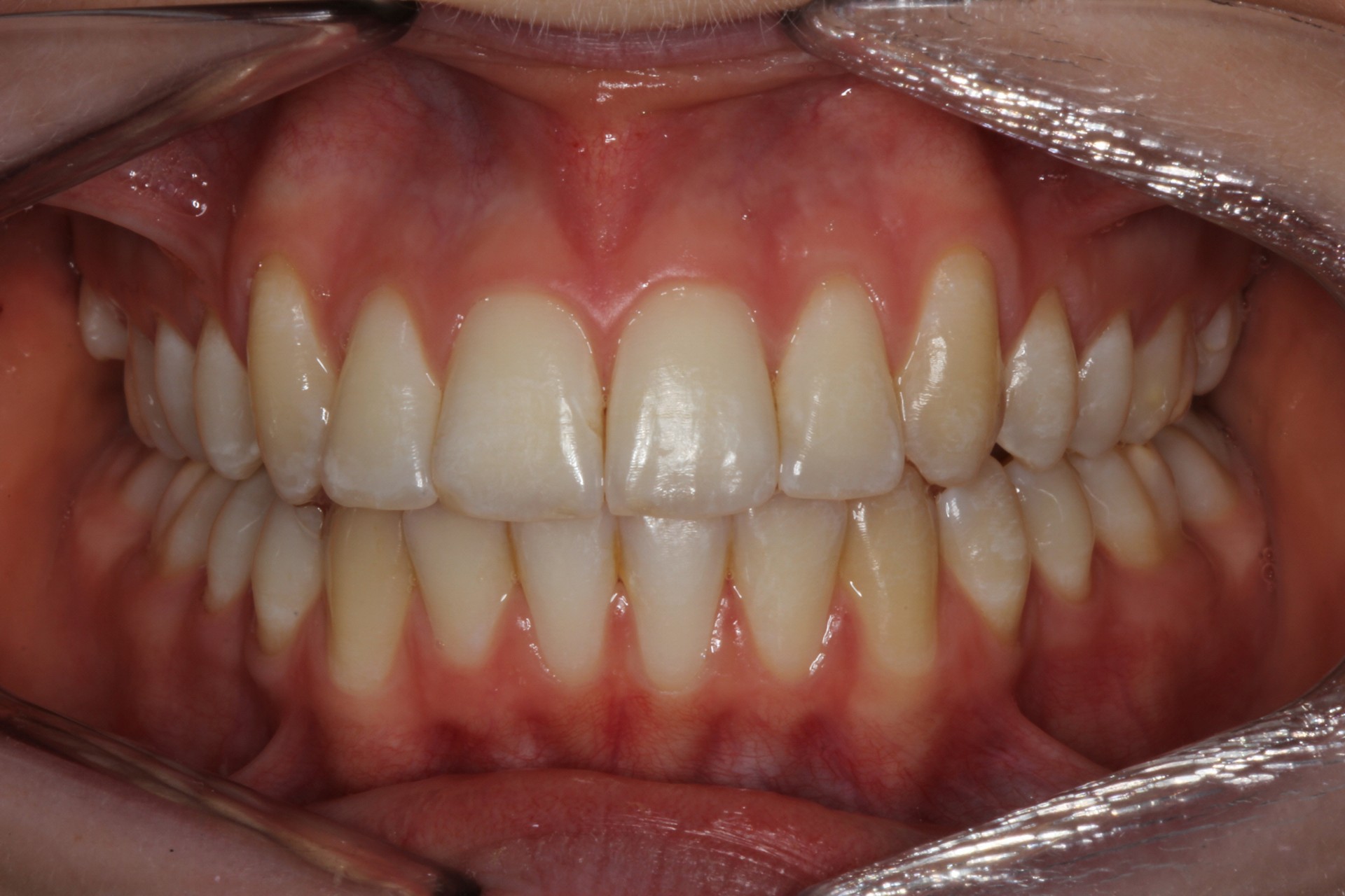 Protruding Front Teeth Contour Orthodontists