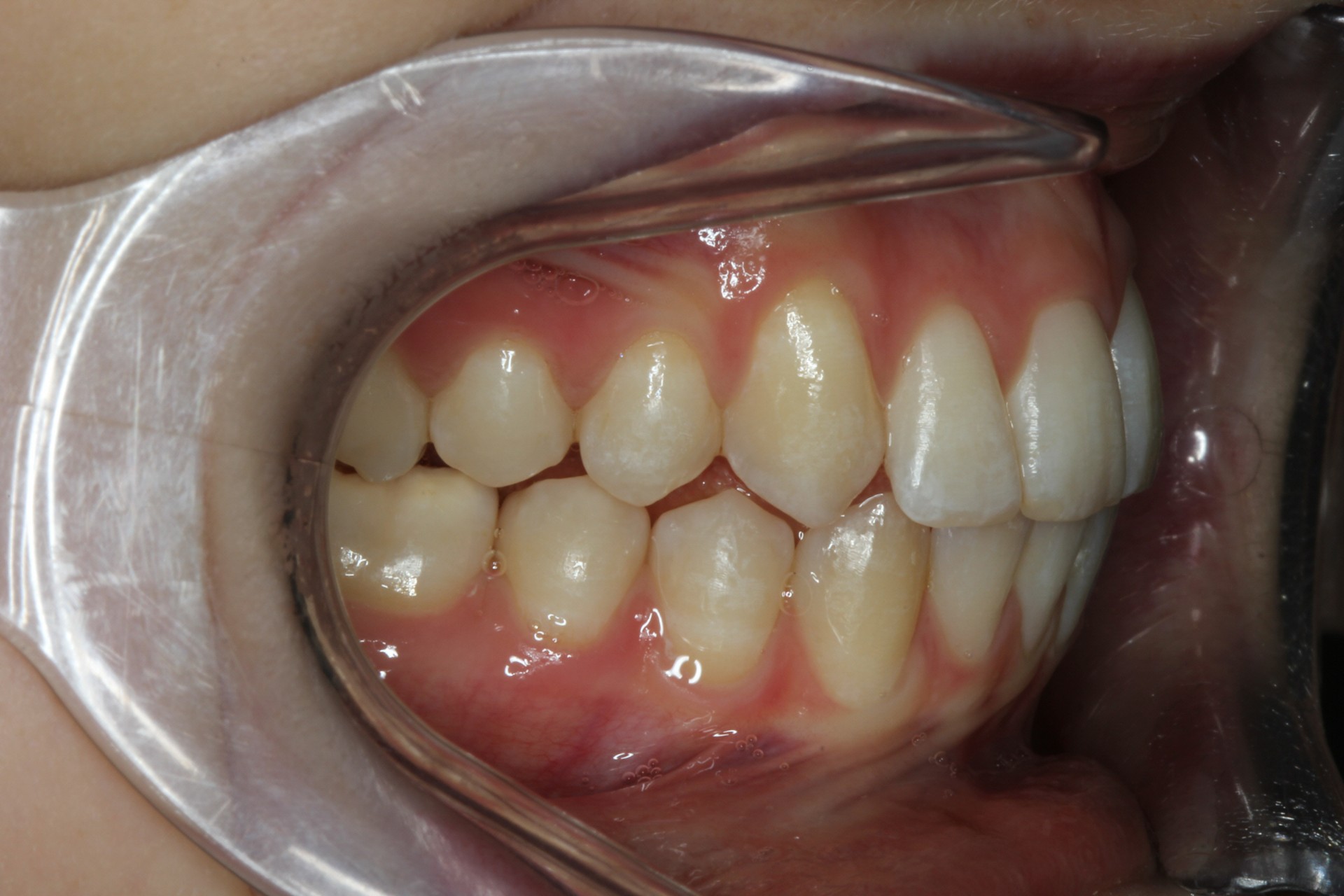 Protruding Front Teeth Contour Orthodontists